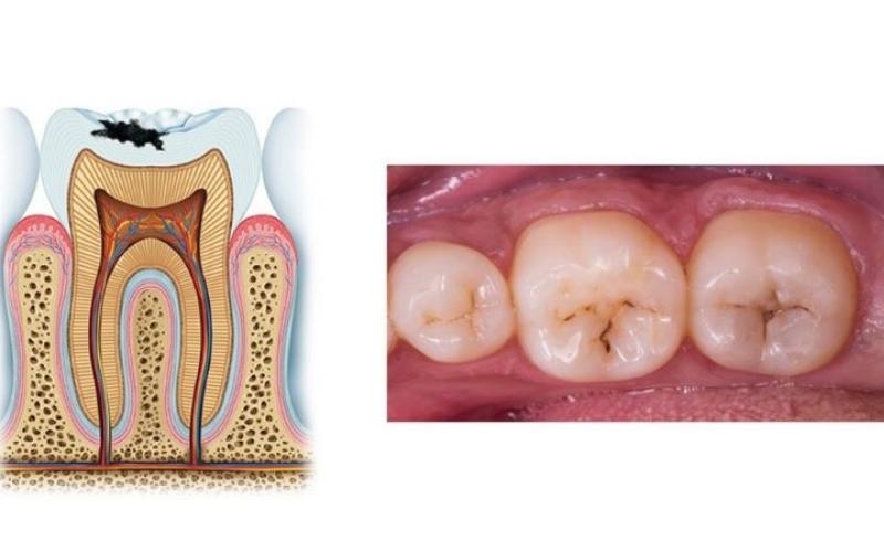 4 giai đoạn sâu răng và cách điều trị