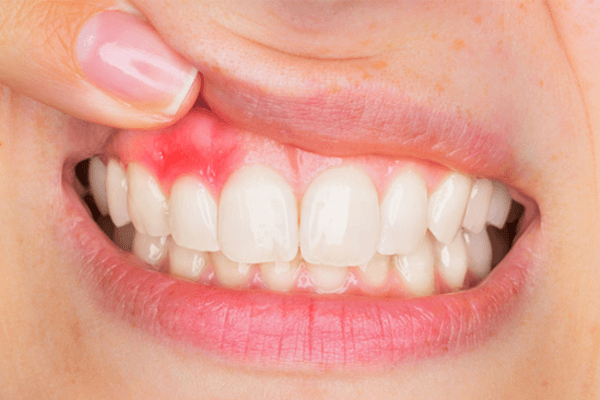 Chảy máu chân răng - Nguyên nhân & Dấu hiệu bệnh gì?