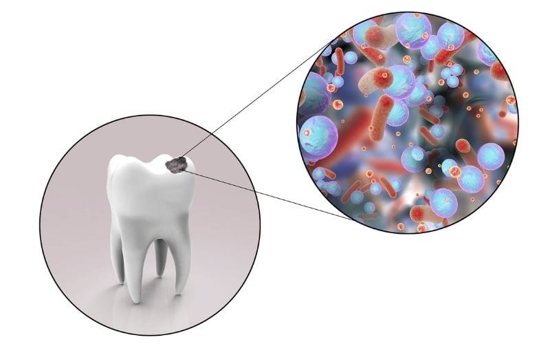 Cơ chế hoạt động vi khuẩn sâu răng như thế nào? Ảnh hưởng và cách phòng ...