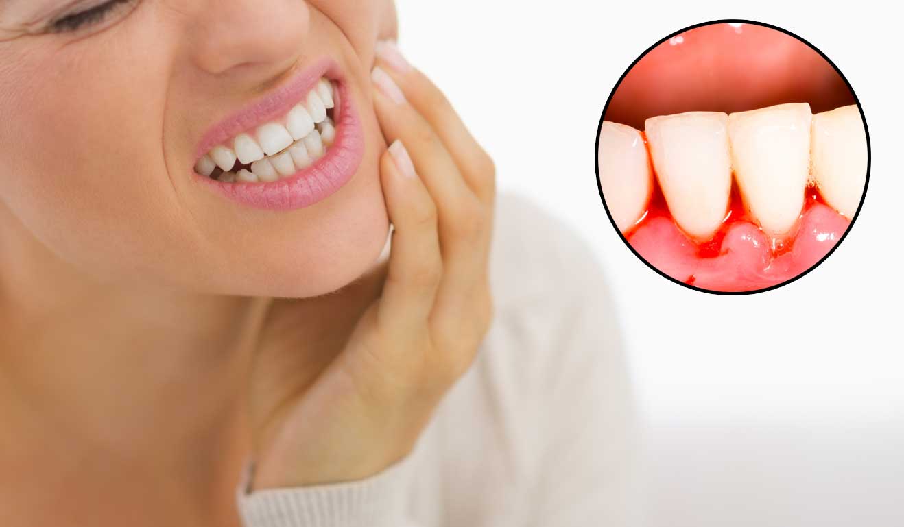 Chảy máu nướu răng: Những điều cần biết
