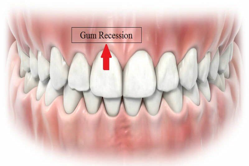Làm gì khi niềng răng bị tụt lợi?
