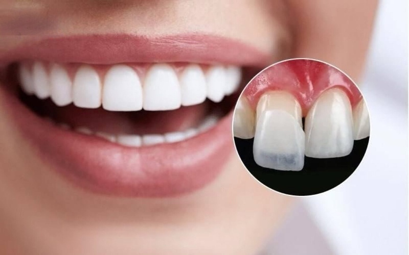 Làm cầu răng sứ có tốt không?