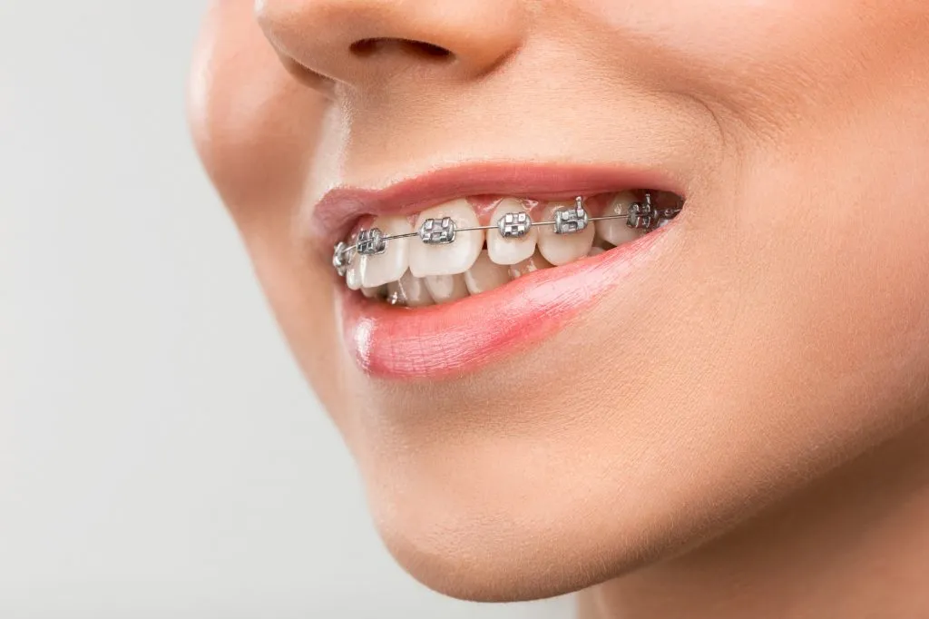 Ưu, nhược điểm và quy trình của niềng răng mắc cài kim loại