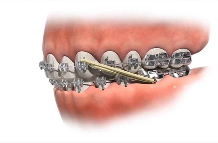 Tác dụng của thun niềng răng là gì?