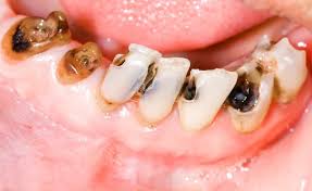 Những điều cần biết để bảo vệ răng miệng