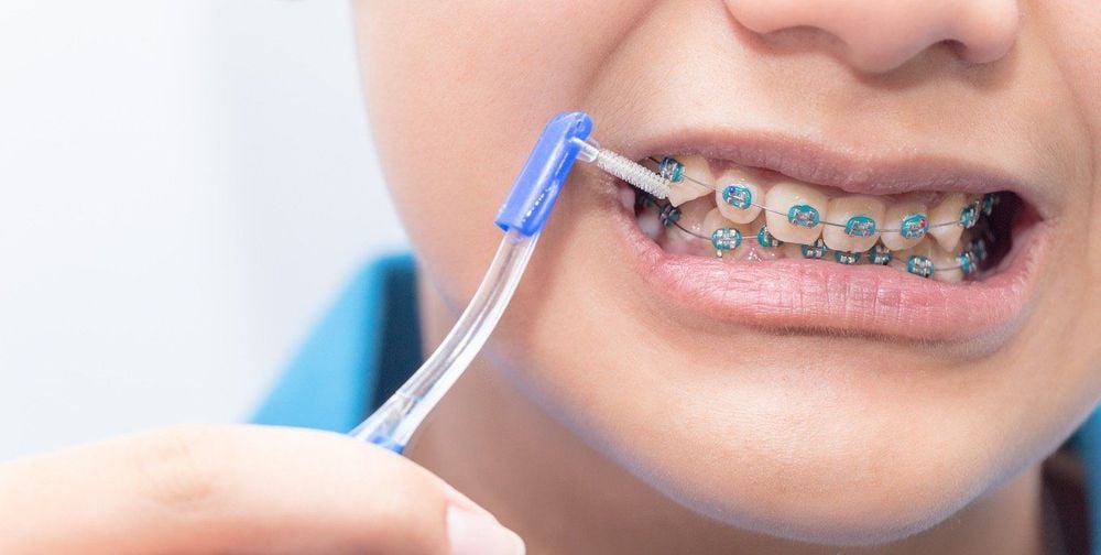 Hướng dẫn lựa chọn và sử dụng bàn chải cho người niềng răng