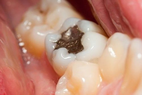 Trám răng có gây hại cho răng lân cận không?
