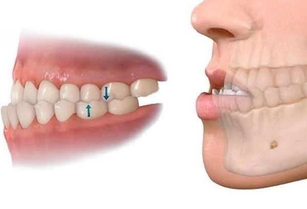 Bị móm có nên niềng răng