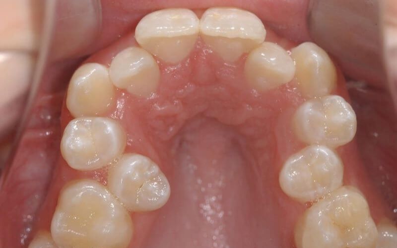 Nguyên nhân và ảnh hưởng của răng mọc chen chúc