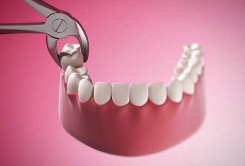 Niềng răng có cần phải nhổ răng khôn không