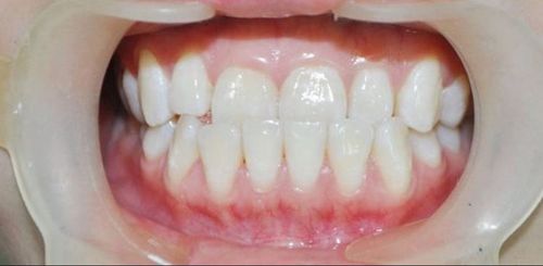 Lệch khớp cắn: Nguyên nhân và điều trị