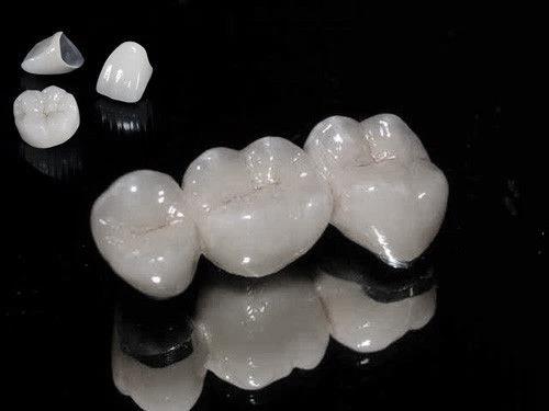 Răng sứ kim loại có tốt và bền không