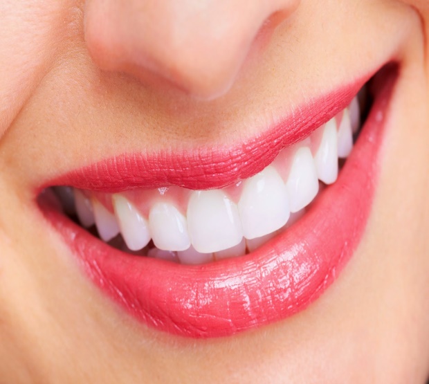 Tại sao niềng răng lại phổ biến như hiện nay?