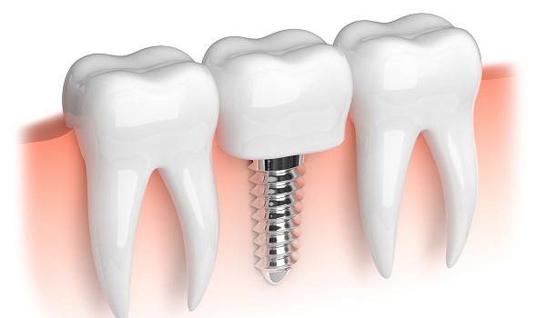 Ai mất răng cũng có thể cấy ghép được răng implant?