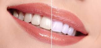 So sánh phương pháp tẩy trắng răng tại phòng khám và tẩy tại nhà