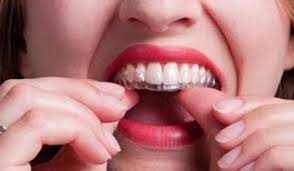Tẩy trắng răng tại nhà được thực hiện như thế nào?