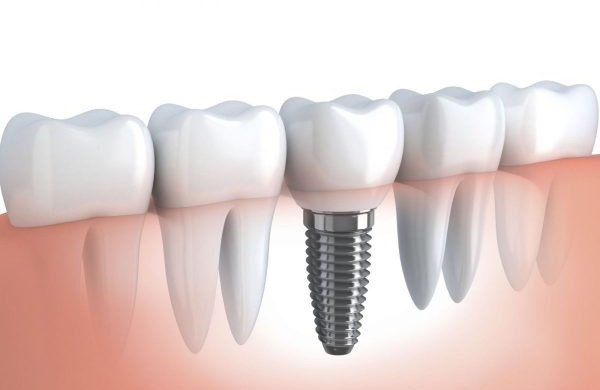 Ưu điểm của công nghệ cấy ghép răng Implant