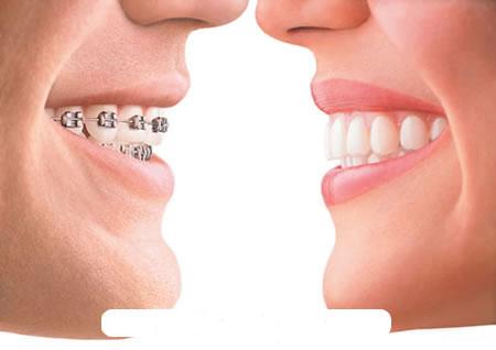 Những vấn đề cần biết về chỉnh hình răng - hàm - mặt