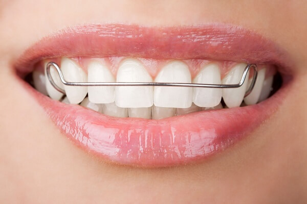 Đeo hàm duy trì sau khi niềng răng | 5 lưu ý quan trọng cần biết