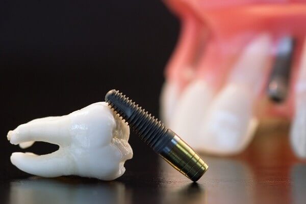 Răng implant bị lung lay nguyên nhân và cách khắc phục