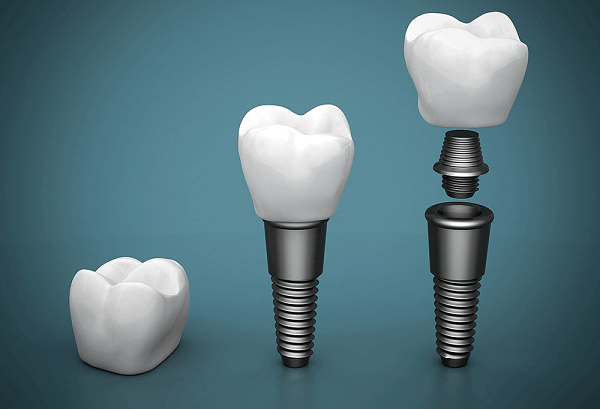 Cấy ghép implant cho người lớn tuổi – Giải pháp trồng răng an toàn, hiệu quả