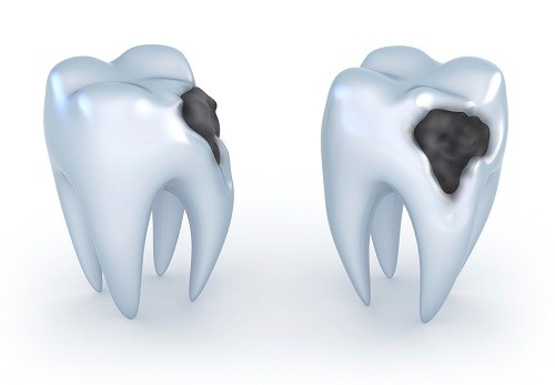 Các giai đoạn viêm tủy răng