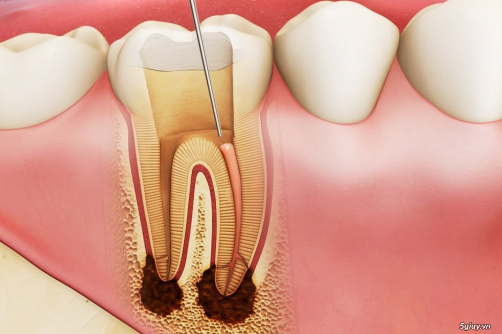 Kiêng gì sau khi lấy tủy răng để tốt cho răng miệng?