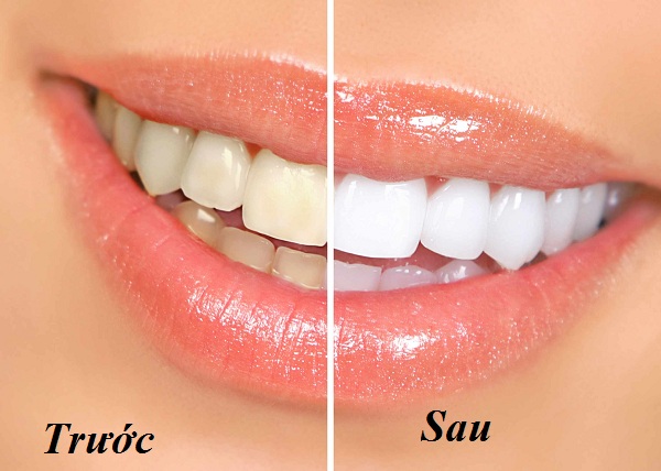 Tẩy trắng răng có làm hỏng men răng không?