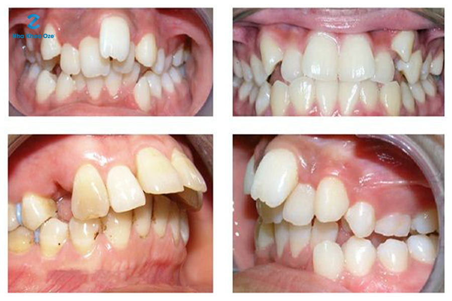 Răng bị mọc lệch bị ảnh hưởng như thế nào đến bé? Cách điều trị răng ...
