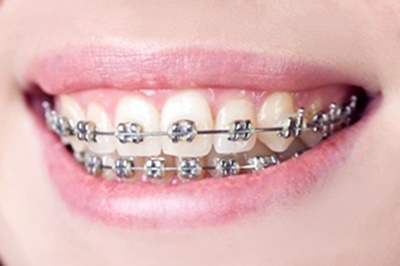 Niềng răng thẩm mỹ phương pháp chỉnh nha hiệu quả vĩnh viễn tại