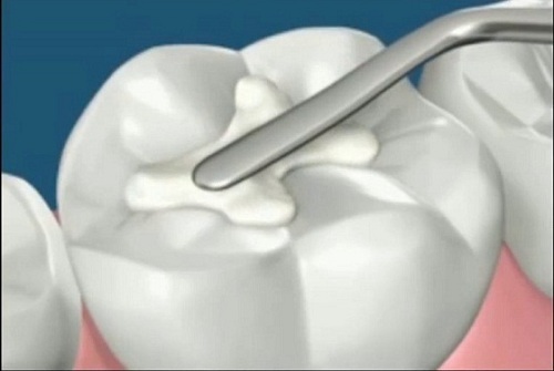 Tại sao một miếng trám thẩm mỹ răng đôi khi bị ê buốt sau khi trám?