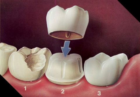 Những yếu tố ảnh hưởng đến độ bền và thẩm mỹ của răng sứ