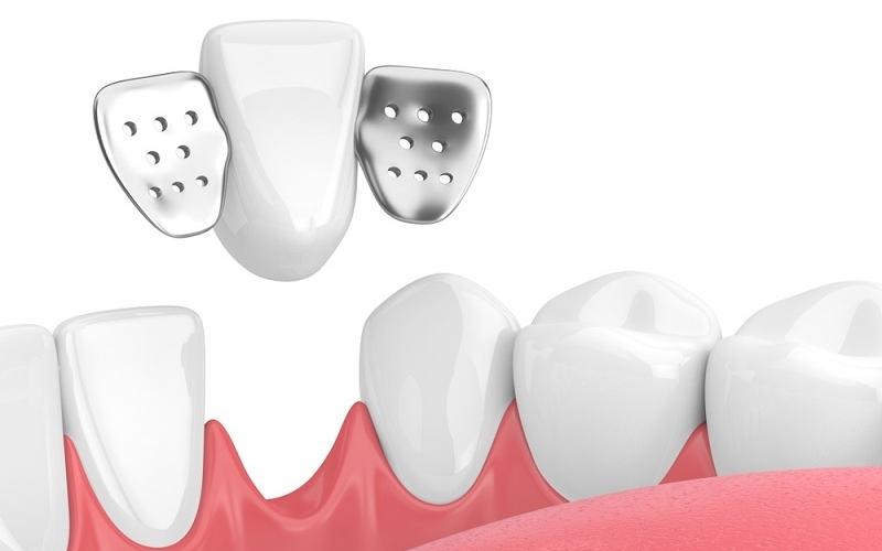 Cầu răng sứ là gì? Làm cầu răng sứ có bền không?