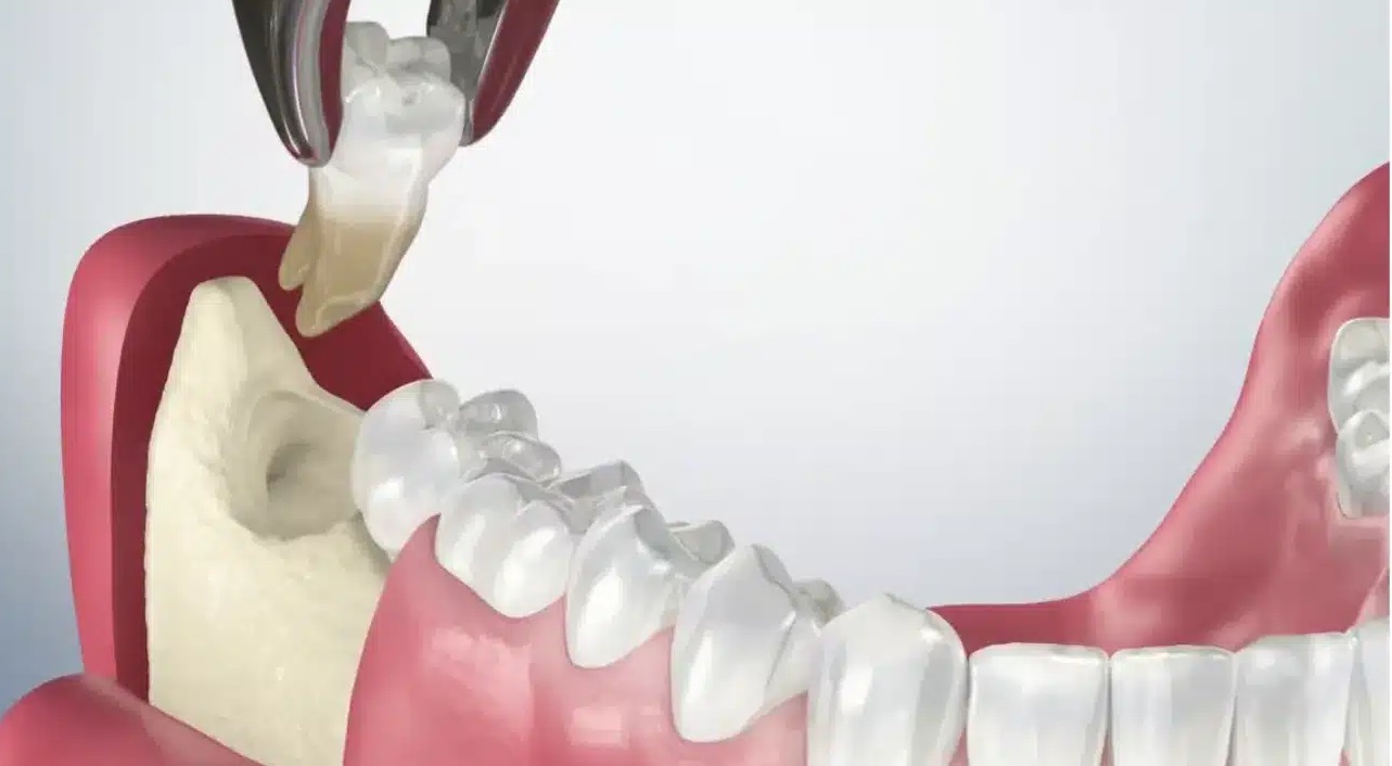 Cách chăm sóc răng miệng sau khi nhổ răng khôn