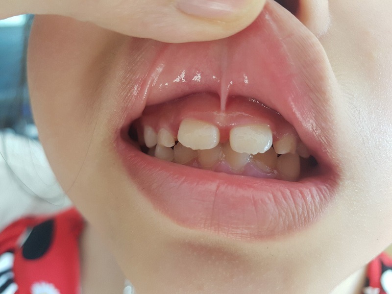 Dính thắng môi ở trẻ và cách điều trị