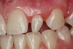 Tình trạng răng nhỏ bất thường – Microdontia