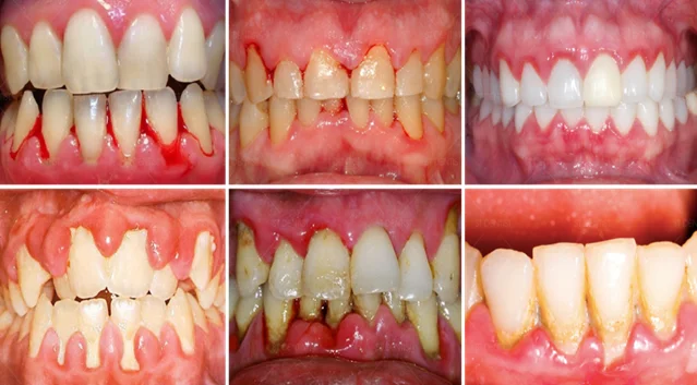 Viêm nha chu là gì? Nguyên nhân, dấu hiệu, chẩn đoán và điều trị